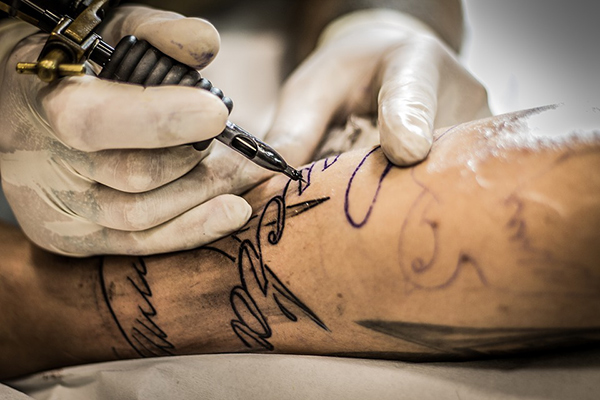 8 Realistic Considerations For Laser Tattoo Removal